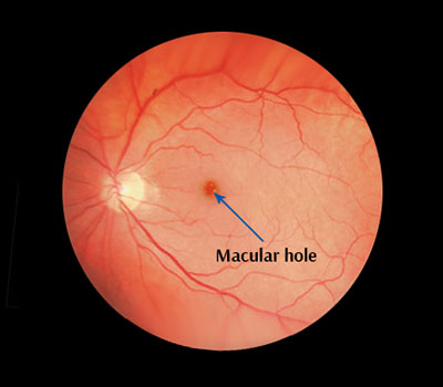 macular-hole
