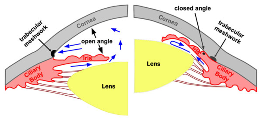 closed vs open angle glaucoma