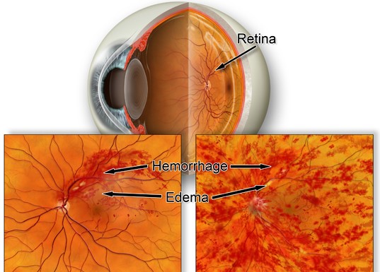 retinal-venous-occlusion