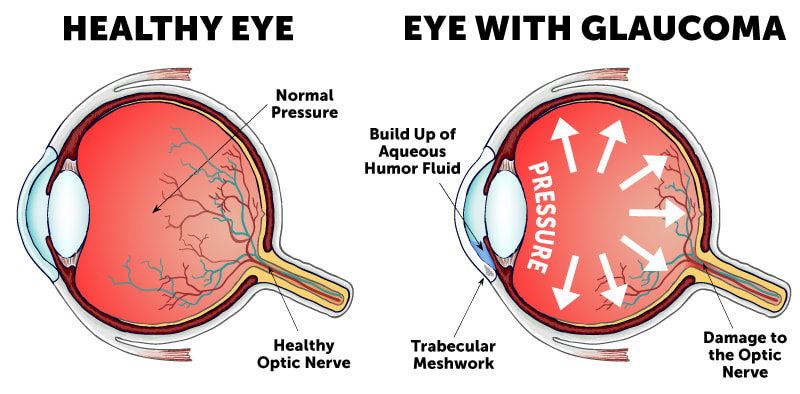 normal-eye-vs-glaucoma