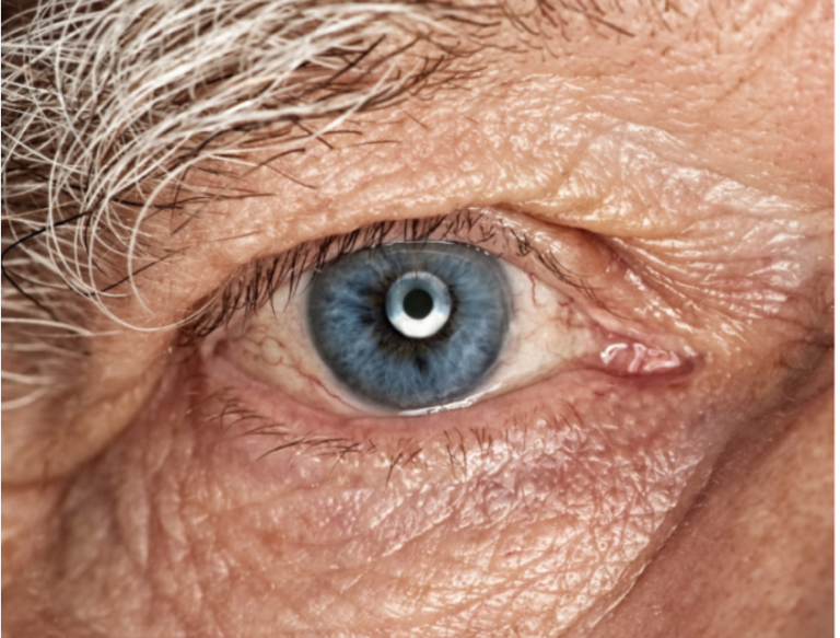 Glaucoma – Important Things You Must Know