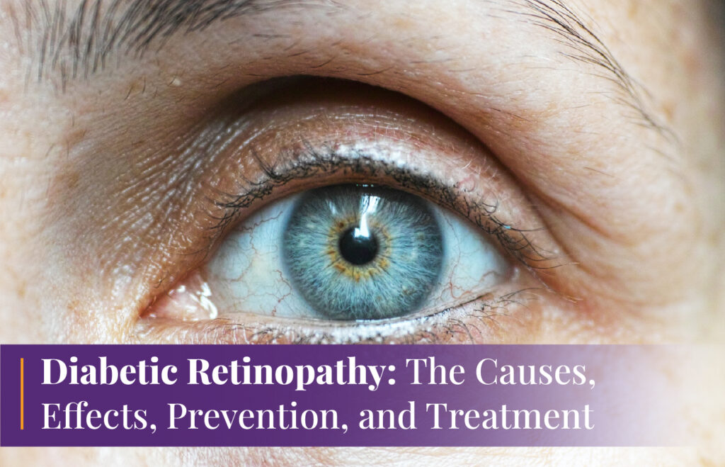 Diabetic Retinopathy causes effects orevention and treatment
